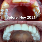 Before and after photos, Full Mouth Reconstruction using Crown and Bridges