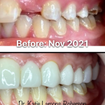 Before and after photos, Patient Smiling- Crown for tooth replacement