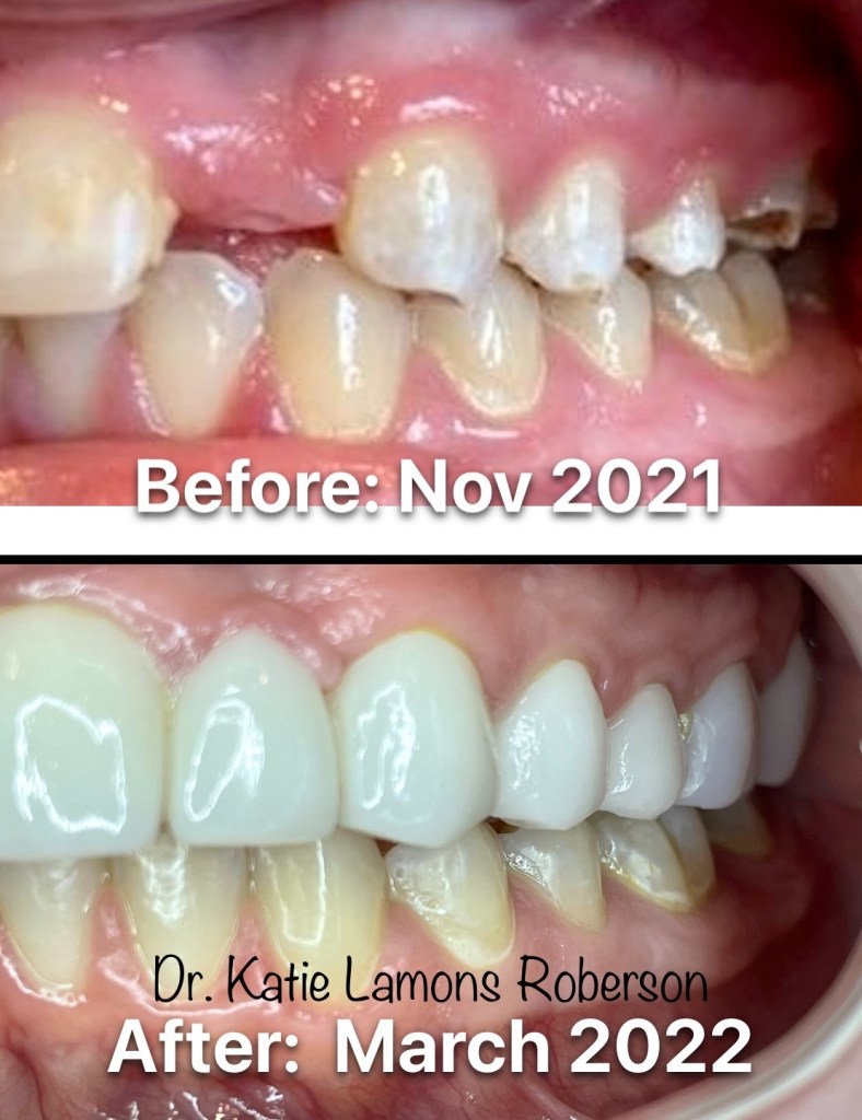Before and after photos, Patient Smiling- Crown for tooth replacement