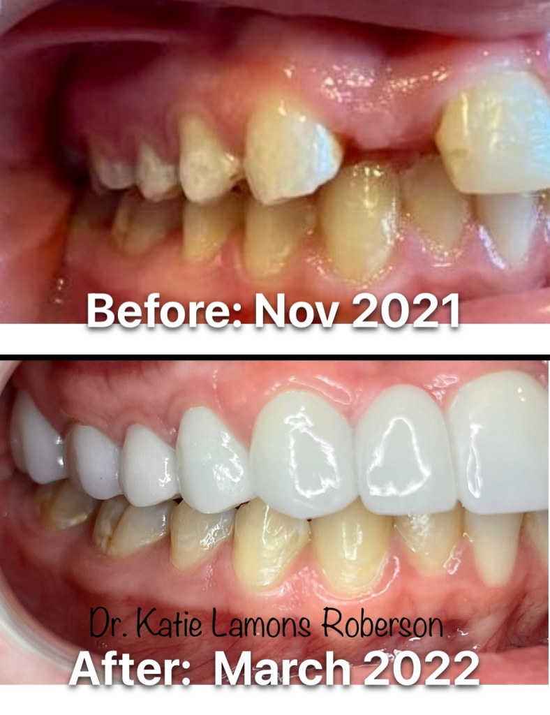 Before and after photos, Patient Smiling- Crown was placed for tooth replacement