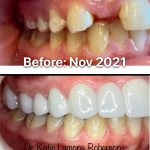 Before and after photos, Patient Smiling- Crown was placed for tooth replacement