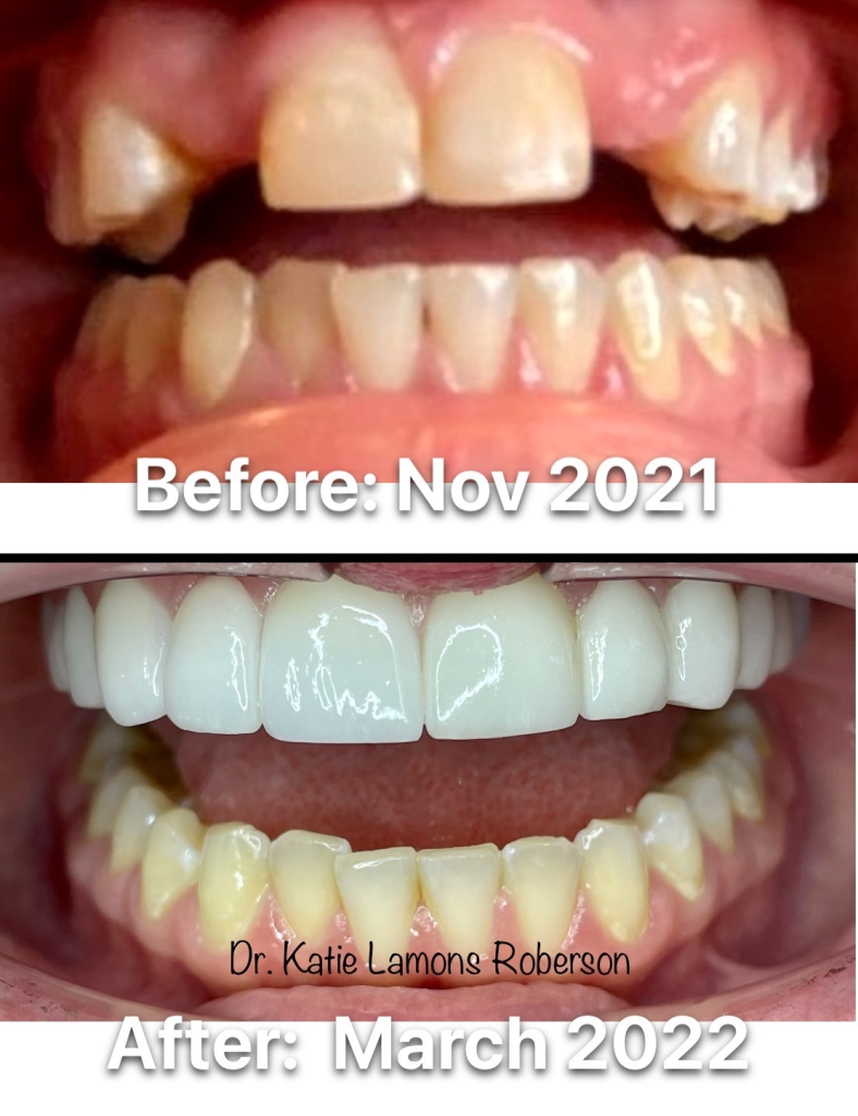 Before and after photos, Patient Smiling- Full Mouth Reconstruction using Crown and Bridges