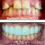 Before and after photos, Patient Smiling- Full Mouth Reconstruction using Crown and Bridges