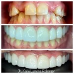 Before and after photos, Patient Smiling showing Full Mouth Reconstruction