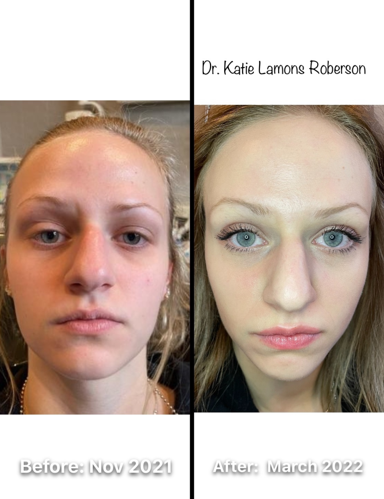 Before and after, jaw/chin shape improved through Full Mouth Reconstruction