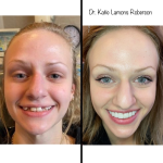 Patient Smiling | Before and after full mouth reconstruction