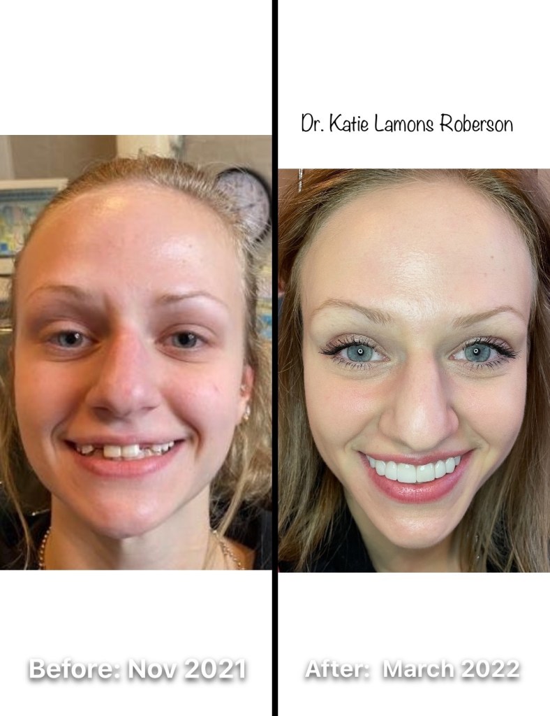 Patient Smiling | Before and after full mouth reconstruction