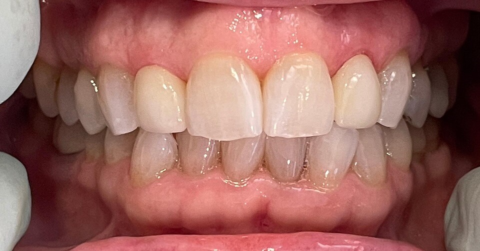 Smile after veneer placement