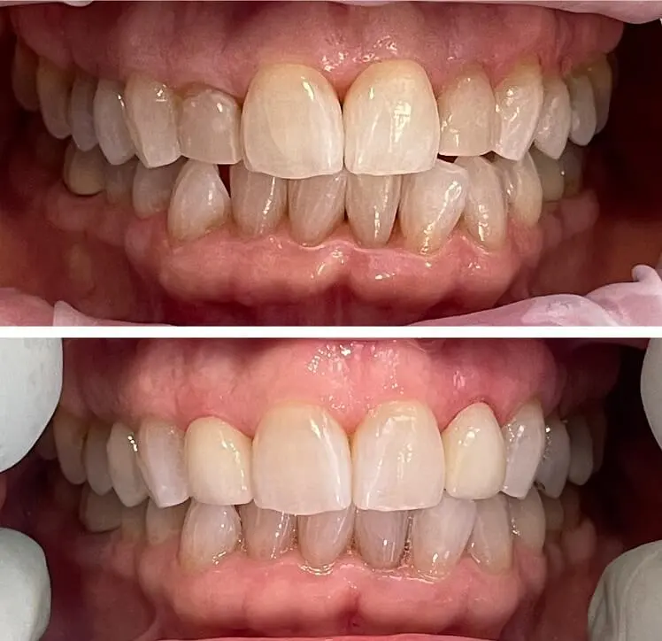 Smile comparison before and after the placement of veneers