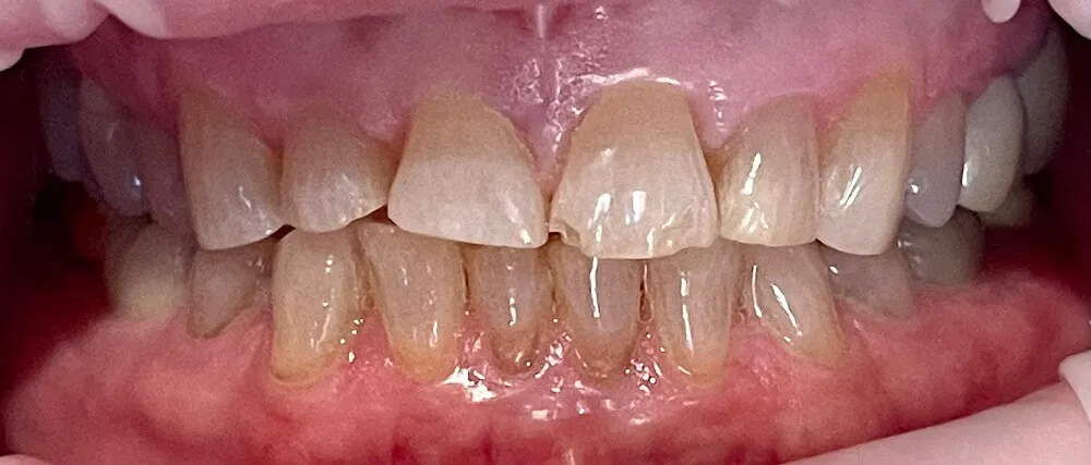 Smile before dental crowns